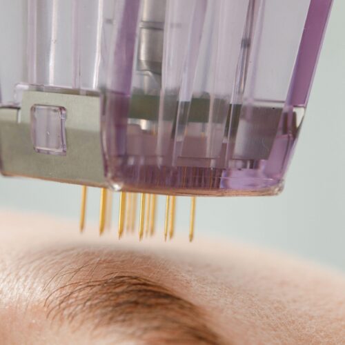Microneedling treatment in Boston for acne scars and skin texture improvement at Kerry Spindler Bespoke Aesthetics Spa