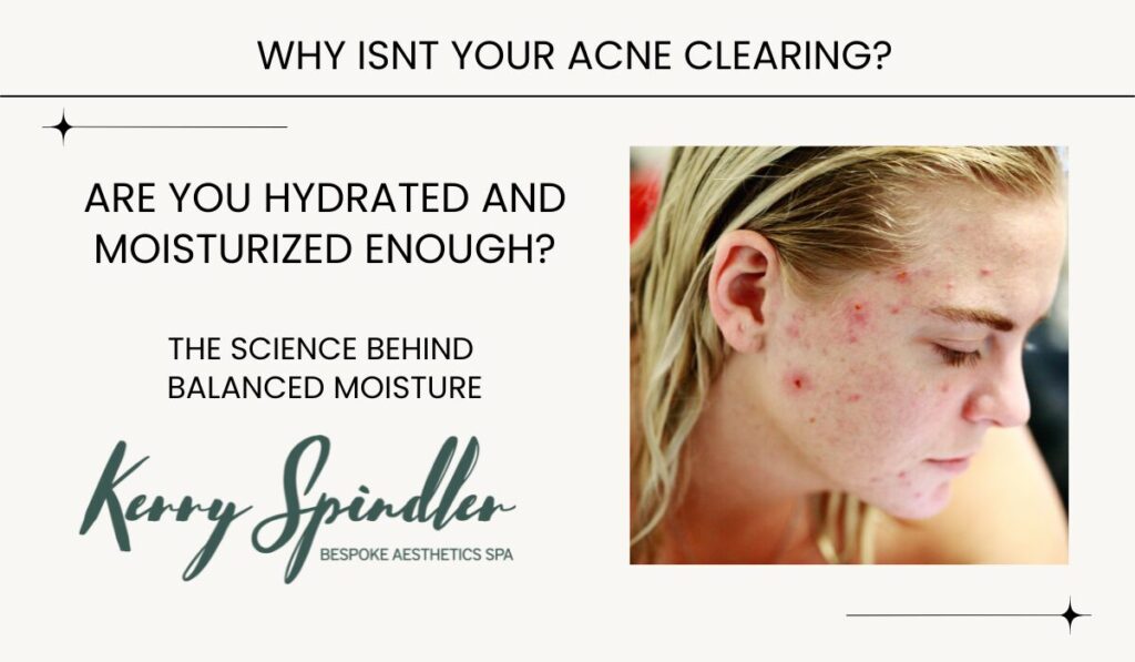 Importance of keeping Acne Prone Skin Balanced with Hydration and Moisture