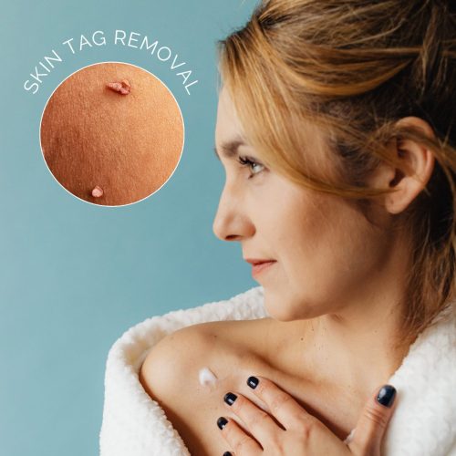 Professional skin tag removal in Boston focused on precision and gentle skin care