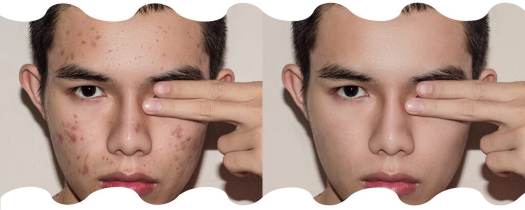 hormonal acne facial treatment in Winthrop MA skincare practice