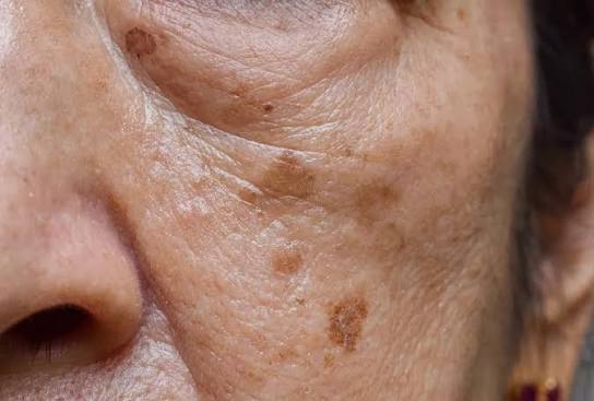 Treating age spots at Kerry Spindler Bespoke Aesthetics Spa