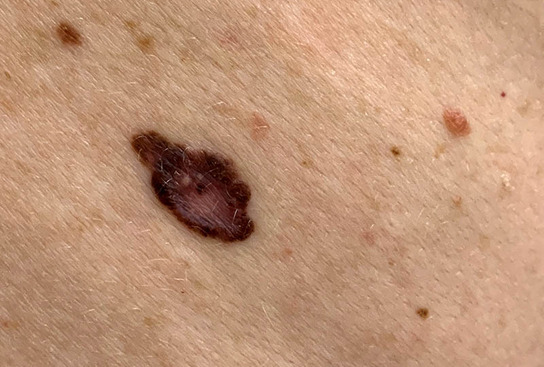 melanoma vs pigmentation