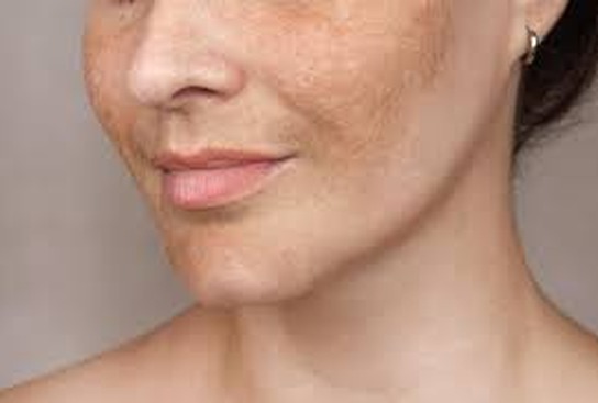 melasma treatment at Kerry Spindler bespoke aesthetics spa near boston