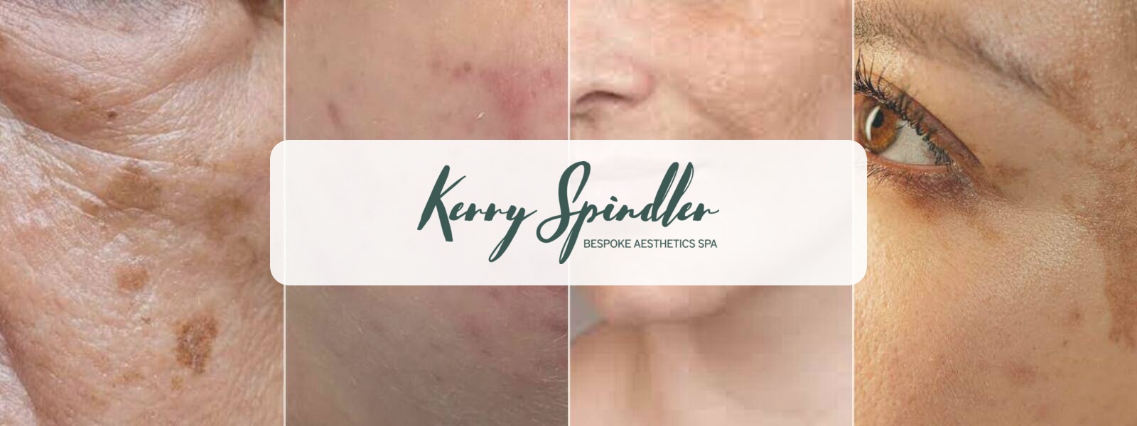 Kerry Spindler Bespoke Aesthetics Spa Treatments for Pigmentation
