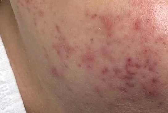 post acne treatment kerry spinder