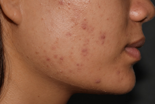 Post Inflammatory pigmentation treatment at kerry spindler