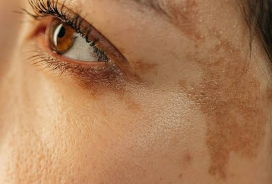 uneven skin tone treatment at Kerry spindler bespoke aesthetics spa