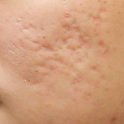 treating boxcar scars near boston