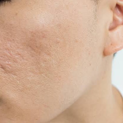 ice pick scar treatment in the boston area