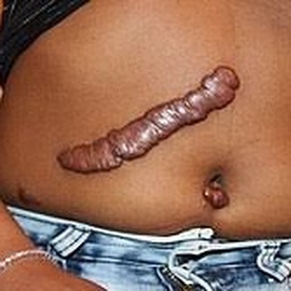 Keloid scars what they look like