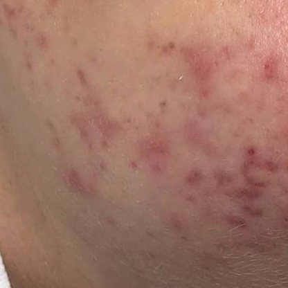post acne discoloration square