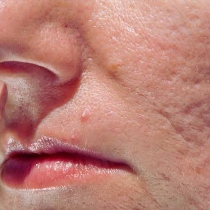 rolling scar treatment near boston